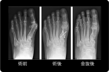Mann変法の説明図