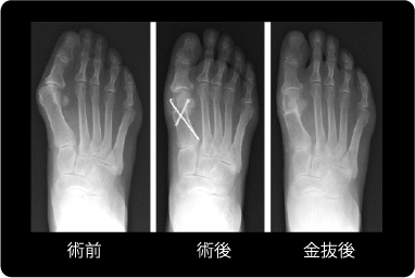 Hammond法の説明図