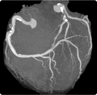 虚血性心疾患のCTアンギオグラム画像