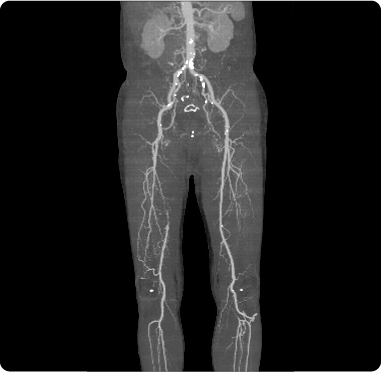下肢閉塞性動脈硬化症の血管画像