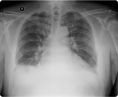 心不全の胸部X線画像