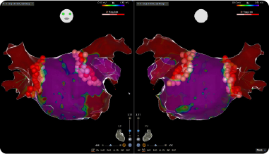 不整脈の電気生理学的マッピング画像