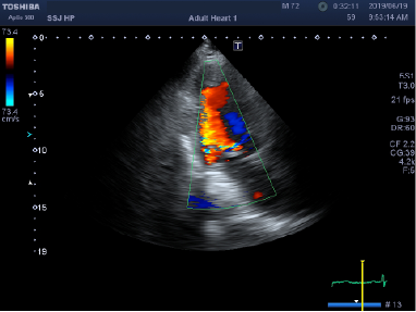 心臓弁膜症の心エコー画像
