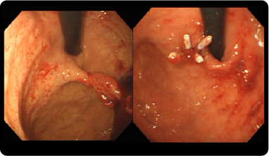 ポリープや早期消化管がんの内視鏡画像