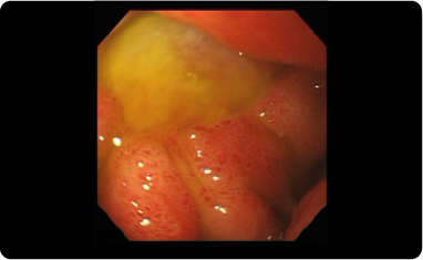 ピロリ菌除菌治療の画像