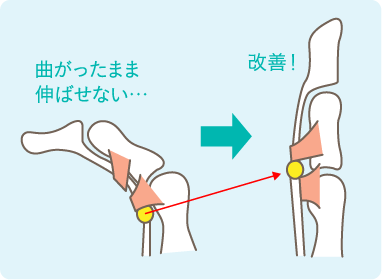 腱鞘炎（ばね指）の説明図
