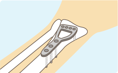 橈骨遠位端骨折の治療説明図