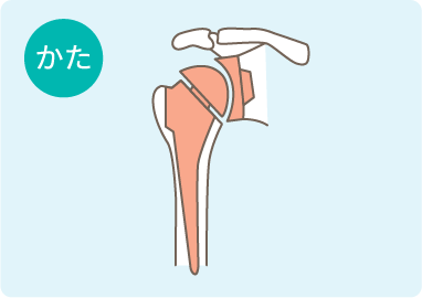 人工肩関節の図解