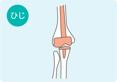 人工肘関節の図解