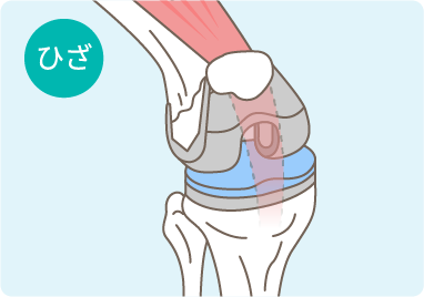 人工膝関節の図解