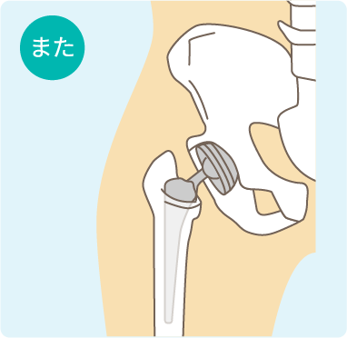 人工股関節の図解