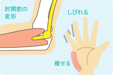 変形性肘関節症の説明図
