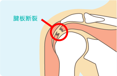 肩の腱板断裂の説明図